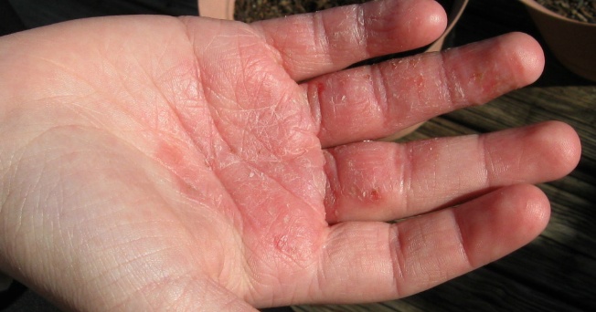 El lago en rossii para el tratamiento de la psoriasis